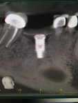 Figure 10 Radiographs from
3-month postoperative visit showing new bone growth.