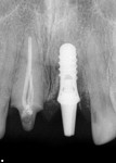 Figure 3 Preoperative radiograph of tooth No. 9, showing
the implant and crown.
