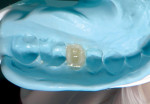 Figure 3 After removal from the mouth, Integrity Multi-Cure Temporary Crown and Bridge Material will self-cure in 5 minutes from the start of mixing.