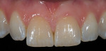 Figure 17  Close-up image of maxillary anterior teeth taken using the dental contrastor.