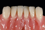 Final result of customizing an anterior dental arch with PALA cre-active