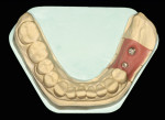 Figure 1. Implant master cast with artificial gingiva and two implants (Astra Osseo Speed) at sites 35 and 36.