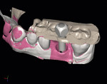 Figures 4 and 5. Lava Scan ST (3M ESPE) offers
scanning of implant models created in the
laboratory and direct transfer of the resultant
data to Astra Tech (Mölndal, Sweden).
