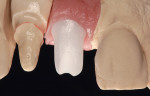 Figures 12 and 13. Zirconia monoblock abutment to be used with a Straumann Bone Level RC implant.