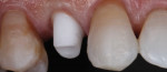 Figure 2. The customized zirconia abutment is ideal for cemented single units in the esthetic zone. The margins should be placed no deeper than 1 mm to aid the
clinician in cement removal.