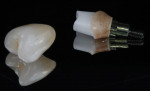 Figure 3. Zirconia abutments (NobelProcera) can be custom shaded to enhance the soft tissue color and prevent future esthetic issues should the gingiva recede.
Many clinicians prefer the zirconia abutments with a titanium insert as seen here.