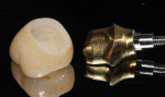 Figure 5. The use of custom titanium abutments
(DENTSPLY Atlantis) is beneficial in single-unit
posterior cases. The custom abutment allows
proper support of the soft tissue, ideal margin
placement, and a more well-supported crown.
The titanium nitride coating (gold) on this
abutment helps lessen (but not eliminate) color
changes of the soft tissue.