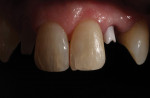 Figure 9. A custom zirconia abutment is used in the anterior maxilla in a patient with a high lip line and thin gingival biotype. The facial margin is at –1.0 mm, mesial and distal at –0.5 mm and the palatal margin at 0 mm.