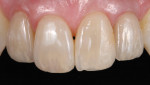 Figure 10. The definitive cemented crown on the right lateral incisor is a porcelain jacket (Vita VM®9, Vident, vident.com) and on the left lateral layered zirconia (NobelProcera/Vita VM9). All laboratory work by Yi-Yuan Chang, MDC.