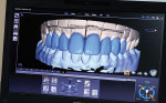 Figure 3. CAD/CAM technology has become a
standard in Fincher’s laboratory. The ease of
use is not limited to single restorations; it’s used daily on multiple-unit cases, as well as high-end cosmetics.