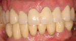 Figure 6  The patient retains a failing eight-unit fixed partial denture.