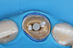 H | Fibercone® Posts for Wide/
Flared Canals