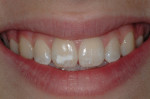 Figure 1  A full-smile preoperative view of a patient with hypoplastic enamel defects on the maxillary central incisors.