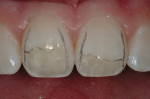 Figure 4  The tooth preparation is completed on both of the maxillary central incisors.