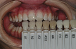 Figure 5  The dentin shade was chosen using the shade guide after the preparation was completed. This allows a more accurate match of the underlying tooth structure.