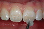 Figure 7  After air-drying the tooth surface, it was rewetted with a desensitizer to help seal the dentinal tubules with hydroxyethyl methacrylate and fluoride before the application of the bonding agent.