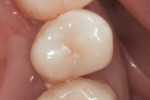Figure 1 Example of occlusal and free-surface early non-cavitated lesions.