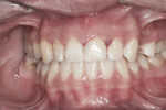 Figure 2 Example of occlusal and free-surface early non-cavitated lesions.