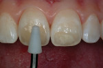 Figure 14  The cone tip of the composite placment instrument was used to shape the dentin increment.