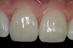 Figure 19  A 2X view of the completed restorations on teeth Nos. 8 and 9. Note how the restorative material blends with the surrounding tooth structure.