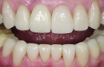 Figure 11 Mandibular anteriors seated with eCEMENT™ translucent light cure as in the technique described above.