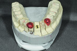 Figure 5 Maxillary cast returned from laboratory with reduction copings for two preparations. Posterior crowns were already completed on the maxillary arch at this point. Posts and
cores were completed on teeth Nos. 12 through 14 utilizing BISCO’s D.T. Light-
Post® and Core-Flo™ DC build-ups.