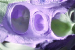 Figure 4 Final impression of tooth No. 21 using Aquasil Ultra Cordless Tissue Managing Impression System (DENTSPLY Caulk).