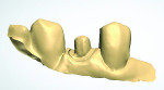 Figure 5 Scan of final impression of tooth No. 21, buccal view, using 3Shape™ scanner (www.3shape.com).