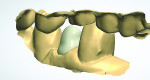 Figure 6 Scan of fi nal impression of tooth No. 21 using 3Shape™ scanner, showing the planning of the zirconia coping.
