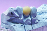 Figure 10 Final layered zirconia crown on the stone die, buccal view.