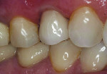 Figure 5 The in-house ceramist then layered ceramic over the facial surface of the zirconia substructure for fi nal
seating. This allowed for customized esthetics while maintaining the strength of zirconia.