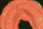 Figure 4 An impression was made using a full-arch, mandibular perforated metal tray with Sharp™ Heavy-Body and Wash Premium VPS (Parkell, Inc.) using a two-step technique. A mandibular tray was used to provide a greater
adaptation of the tray to the lingual
side of the soft tissue. The impression needed to capture the buccal flange above the gingival cleft.