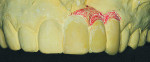 Figure 3b Models showing the “before” and “after” mock-up. The treatment goal of the final fixed prosthesis was
to correct the midline cant, close the apical opening under the pontics, and shorten the lengths of the left
central incisor, lateral incisor, and canine using a custom gingival shade of porcelain. A vacuum stent was made from the mock-up model to aid in the fabrication of the provisional restoration.
