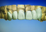 Figure 7a Using 3Shape™ software
(www.3shape.com), a scan of the
provisional model was superimposed
onto the digital proposal to duplicate
incisal position and length. The software program was able to blend
the two models together.