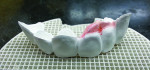 Figure 8 The six-unit prosthesis is shown on the fi ring tray prior to sintering. Pink stain was applied where the artificial gingiva would be displayed.