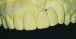 Figure 3a Models showing the “before” and “after” mock-up. The treatment goal of the final fixed prosthesis was
to correct the midline cant, close the apical opening under the pontics, and shorten the lengths of the left central incisor, lateral incisor, and canine using a custom gingival shade of porcelain. A vacuum stent was made from the mock-up model to aid in the fabrication of the provisional restoration.