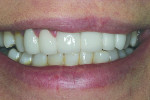 Figure 12 The patient showed a relaxed smile with the fi nal restoration.