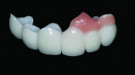 Figure 10 The completed final restoration with the artificial gingival
display. During try-in, single-sided AccuFilm® I (Parkell, Inc.) was used to determine the intensity of the contact from the adjacent teeth. AccuFilm® I can also be used if any areas on the prepared teeth prevent the full seating of a restoration. An inked spot would show exactly the area to be adjusted. After the patient approved the try-in, the intaglio surfaces were cleaned. Brush&Bond® adhesive (Parkell, Inc.) was applied to the abutment teeth, air-thinned, and light-polymerized. SEcure® adhesive resin cement (Parkell, Inc.) was used to cement the restoration.