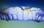 Figure 7b Using 3Shape™ software
(www.3shape.com), a scan of the
provisional model was superimposed
onto the digital proposal to duplicate
incisal position and length. The
software program was able to blend
the two models together.