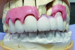 Figure 9 The prosthesis was placed on the soft-tissue working model. At this point, the incisal one-third was cut-back to allow for layering of incisal porcelain. Using the customized gingival
composite shade tab, the laboratory was able to create the correct gingival shade porcelain.