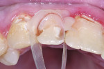 Figure 5 Using an anatomical mylar matrix (Margin Perfect Matrix [MPM], CVR Enterprises) is an efficient way to
perform large direct composite restorations. Notice the sulcular
separation and tooth isolation.
