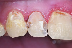 Figure 3 After local anesthesia, decay was removed and a calcium-silicate
liner was placed where the preparation approached the pulp.