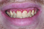 Figure 1 The patient presented with red, irritated gums due to several potential causes, including at least poor hygiene, decay, and mouth breathing.