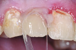 Figure 7 A layer of Beautifil Flow was placed over the liner and dentin in a 0.5 mm to 1 mm layer. The more flowable material was applied, left uncured, and followed by application of Beautifil II.