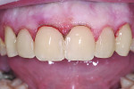 Figure 11 After 10 restorations were placed, the Giomer material mimicked other microhybrid composites esthetically, but the fluoride release and rechargeability provided restoration protection so an alginate impression was taken.