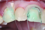 Figure 8 After shaping with a finish diamond, the adjacent teeth were restored in the same fashion using a mylar strip and MPM.
