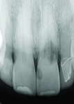 Figure 2 A periapical radiograph (PA) revealed a large resorptive lesion.