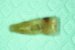 Figure 3 The tooth was extracted and an implant was planned to be placed using CEREC Guide, a chairside-milled guided surgery system.
