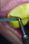 Figure 6 With CEREC Guide, yellow thermoplastic material was adapted to a model, while CEREC milled the guide sleeve portion. Keys guided drills to form the osteotomy in the position that was planned in the GALILEOS software.