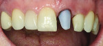 Figure 11 A titanium base was used, and a custom e.max® abutment (Ivoclar Vivadent, www.ivoclarvivadent.com) was milled using the CEREC Omnicam, which was also used to mill out a separate e.max crown.